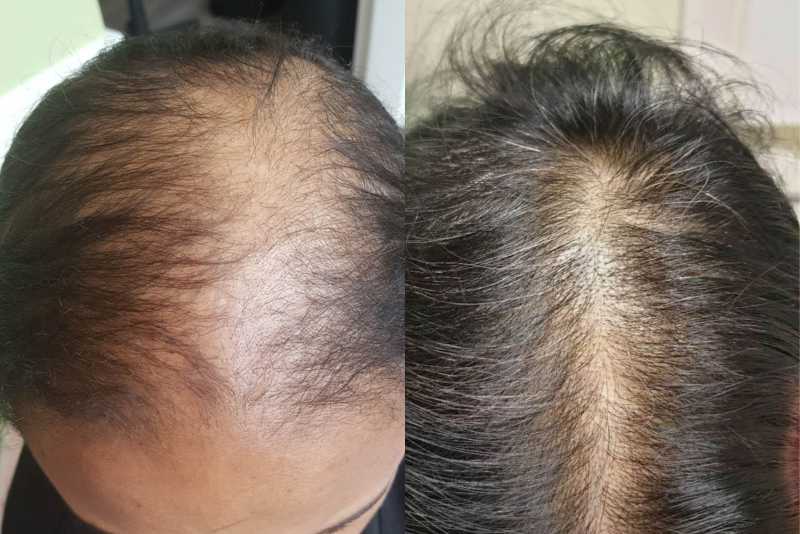 Voor-en-na-foto van een zwartharige man met kale plekken, met zichtbare haargroei op de na-foto.