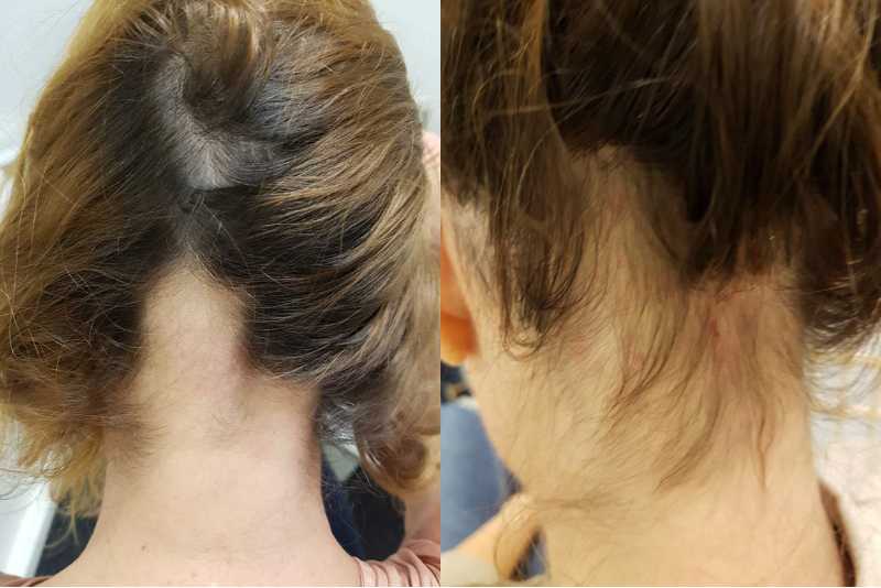 Voor-en-na-foto van een vrouw met een kale plek op het achterhoofd, op de na-foto is nieuwe haargroei te zien.