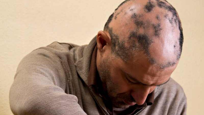 Man in bruine sweater, met kale plekken op het hoofd door Alopecia., naar beneden kijkend.